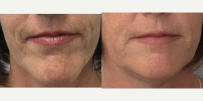 55-64 year old woman treated with Sofwave, Ultherapy - 60 year old woman treated with Sofwave and Ultherapy