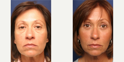 Woman treated with Cheek Lift - Woman treated with Cheek Lift