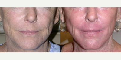 45-54 year old woman treated with MiXto Laser - Mixto Skin Resurfacing is carbon dioxide laser resurfacing at its highest quality. Its calibration requires an expert touch, understanding of how skin reacts to laser light, and how the skin heals after laser stimulation. Our two laser providers, Jessie Mallalieu and Susan Young, are the last word in laser skin resurfacing. Both have over 12 years experience in laser and cosmetic dermatology and will customize your plan to meet your needs safely.
