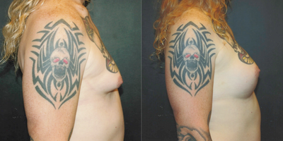 45-54 year old man treated with MTF Breast Augmentation - 500 cc moderate plus silicone implants were placed on top of the muscle through periareolar incisions. The incisions have healed very well.