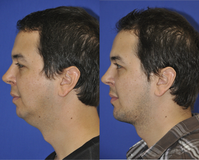 34 Year Old Male, Chin Augmentation and Liposuction of the Neck  - 	This 34 year old male presented to our office seeking an improvement in the appearance of his chin and neck. He desired a more prominent chin which would be in better harmony with the rest of his facial features. He was also seeking a thinner appearing neck with better definition of his jawline. He is shown 2 1/2 months after placement of a large Extended Anatomic Chin Implant (Implantech) and liposuction of the neck, all of which was done through a small (1.5 cm) incision under his chin. The procedure was performed under IV sedation (1.5 hrs) at a surgery center.