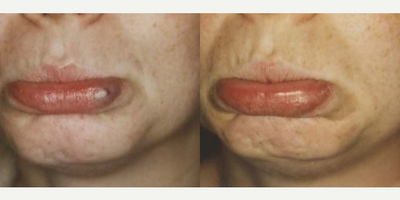 Woman treated with Pulsed Dye Laser - Woman treated with Pulsed Dye Laser