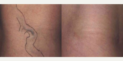 Woman treated with Pulsed Dye Laser - Woman treated with Pulsed Dye Laser