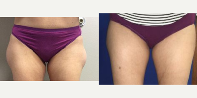 35-44 year old woman treated with Smart Lipo - Patient had liposuction performed to thighs