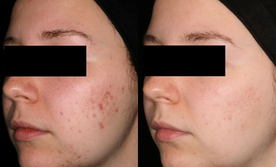 Woman treated with AviClear - Woman treated with AviClear