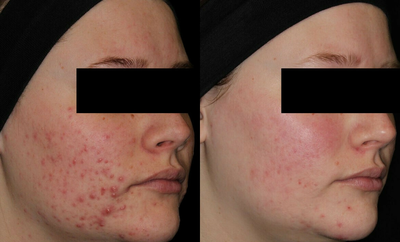 Woman treated with AviClear - Woman treated with AviClear