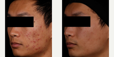 Man treated with AviClear - Man treated with AviClear