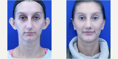 25-34 year old woman treated with Ear Surgery - Ear prominence reduction is carried out comfortably in the office setting under anesthesia. Ridge creation plus removal and overlapping and concha bowl cartilage is required to pin back the ear seen here at one year post.