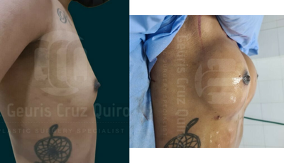 25-34 year old woman treated with Motiva Breast Implants - Patient with breast lift augmentation with Motiva silicone implants 230cc, patient was looking for a little lift after her pregnancies'