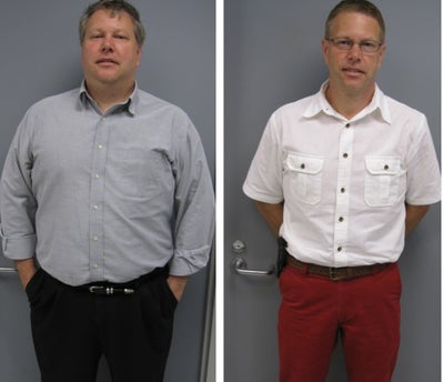 Before & After - 
	6 months post-op
