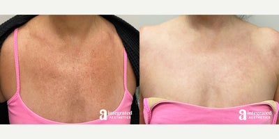 55-64 year old woman treated with IPL - The patient is a 57-year-old female who had concerns with photodamage on her chest/decollete. The area was treated using a series of IPL (Intense Pulsed Light) treatments.The after results are 4 months post-treatment.
