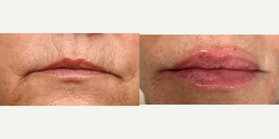 55-64 year old woman treated with Restylane Refyne - Lips treated with Restylane Refyne, perioral area treated with Belotero and marionette lines treated with Vollure.