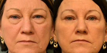 Upper blepharoplasty suture reaction? - Eyelid Surgery forum