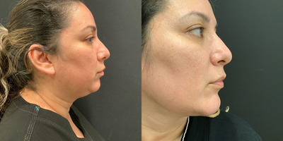 Woman treated with Chin Liposuction - Woman treated with Chin Liposuction
