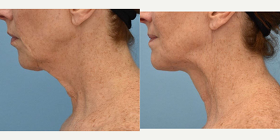 55-64 year old woman treated with Thread Lift - Minimal Invasive Nonsurgical Thread (MINT) PDO