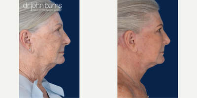Woman treated with Facelift Revision, Neck Lift - Woman treated with Facelift Revision and Neck Lift