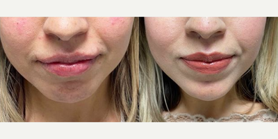 Woman treated with Dysport - Woman treated with Dysport
