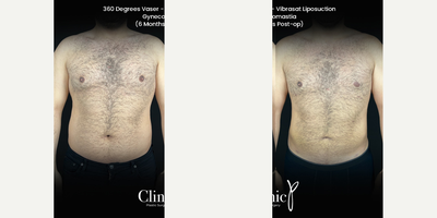 35-44 year old man treated with Vaser Liposuction, Mastectomy - this patient was trated with 360 degrees vaser - vibrasat liposuction and gynecomastia operations. This is 6 months post op.