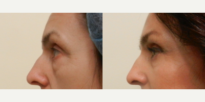 Brow Lift - These are pictures of a Brow Lift and Lower Blepharoplasty. The Art of Plastic Surgery, Dr. Gregory A. Wiener, MD FACS