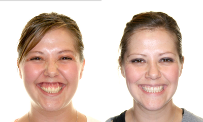 Surgical Orthodontics - 
	Patient had teeth removed to reduce flaring, braces to align the arches, and surgery to move the upper jaw upward and the lower jaw forward
