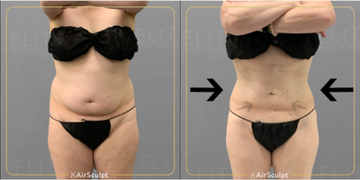 Woman treated with AirSculpt - Woman treated with AirSculpt