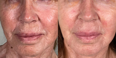 65-74 year old woman treated with Ellacor - 71-year-old woman treated with an Ellacor treatment on the lower third of her face