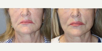65-74 year old woman treated with Thread Lift - Midface and Lower face lift with PDO threads71 y/o F, G5P2, 59, 139 lbs,