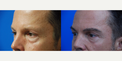 35-44 year old man treated with Eyebrow Transplant - Patient treated with one Eyebrow Transplant of 528 follicles.