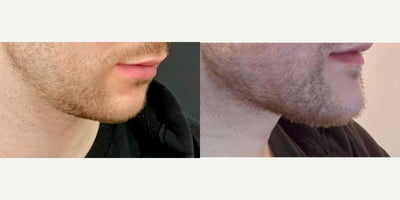 25-34 year old man treated with Chin Implant, Cheek Augmentation, Jaw Implants - Chin & Jaw Implant