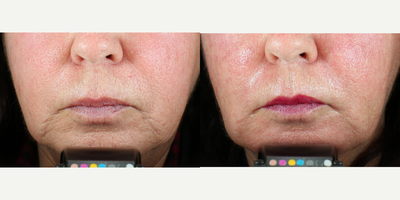 65-74 year old woman treated with Vivace - 67 year old woman treated with Vivace RF Microneedling with Red LED light for marionette lines and nasolabial folds. 3 treatments total, 1 month post-last treatment.