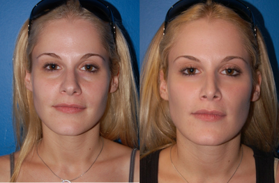 Facial Fat Grafting: Case #3 - 	31 year old female that underwent facial fat grafting and rhinoplasty