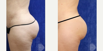 Woman treated with Cellulaze - Woman treated with Cellulaze