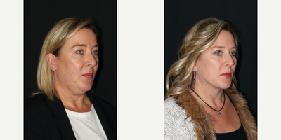 Woman treated with Facelift - This patient wanted to achieve a more refreshed look. She did not want to look like she had surgery. She wanted to look like herself, just better. I performed a facelift, neck lift, and upper blepharoplasty without general anesthesia. She is 3 months postop.
