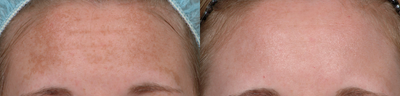 25-34 year old woman treated with Fraxel Laser - 1 month after 1 Fraxel treatment