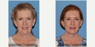 62 year old woman treated with Deep Plane Facelift, Neck Lift, Botox, MACS Facelift - 62 year old woman treated with Deep Plane Face and Neck Lift, Fat Grafting to Cheeks, Botox, MAC