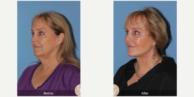66 year old woman treated with Deep Plane Facelift, Neck Lift, Eyelid Surgery, CO2 Laser, MACS Facelift - 66 year old woman treated with Deep Plane Face and Neck Lift, Lower Blepharoplasty, CO2 Laser ofFace, MAC