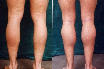 Men's Calf Augmentation  - 
	Men&#39;s Calf Augmentation W/Implants
