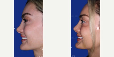 25-34 year old woman treated with Revision Rhinoplasty - 25-34 year old woman treated with Revision Rhinoplasty