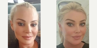 Woman treated with Forehead Reduction - Woman treated with Forehead Reduction andBrow Lift