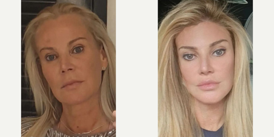 Woman treated with Forehead Reduction - Woman treated with Forehead Reduction andBrow Lift, shown 5 years post op.