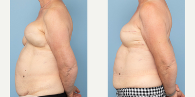 65-74 year old woman treated with Breast Implant Removal, Breast Implants, Breast Implant Revision - 73 years old3 childRemoval of 32 year old -450cc implants (LEFT)Replaced with 375cc saline smooth implant6 weeks post op