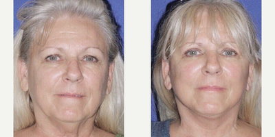 Woman treated with Mini Facelift - Woman treated with Mini Facelift