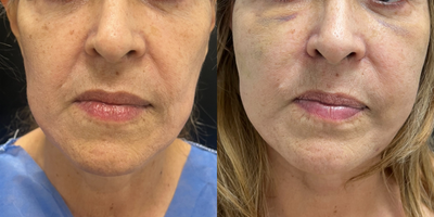 55-64 year old woman treated with Facial Fat Transfer, Facelift Revision - Patient wanted a more youthful appearance of her face after a facelift