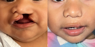1 year old girl treated for Cleft Lip And Palate Repair - Baby had a unilateral cleft lip and palate, lip was repaired at 3 months of age and palate at one year of age