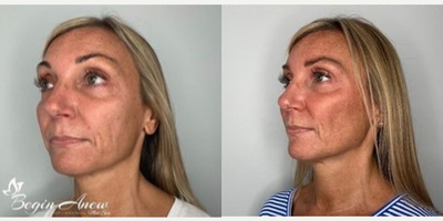45-54 year old woman treated with Restylane Contour - Cheek enhancement