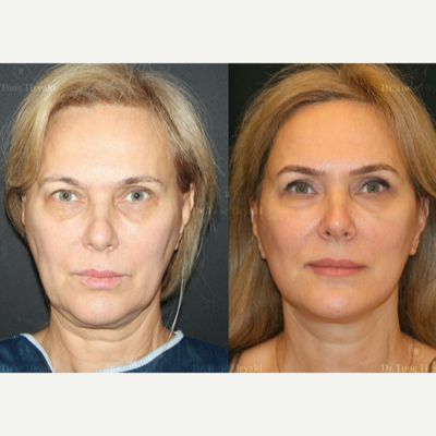 Tunc Tiryaki, MD Reviews, Before and After Photos, Answers - RealSelf
