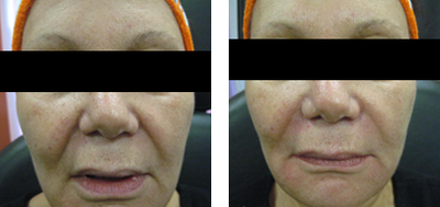 Sculptra before and after photo