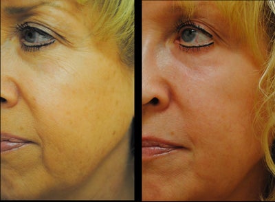 Collagen Injection before and after photo