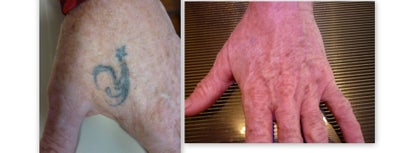 Tattoo Removal before and after photo