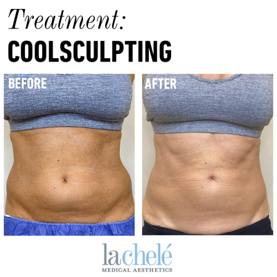 CoolSculpting before and after photo